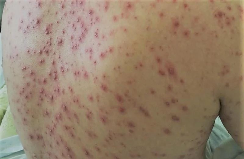 Cẩm Khê (Phú Thọ): Увеличение заражения водянкой, врачи предупреждают о опасных осложнениях при небрежном лечении